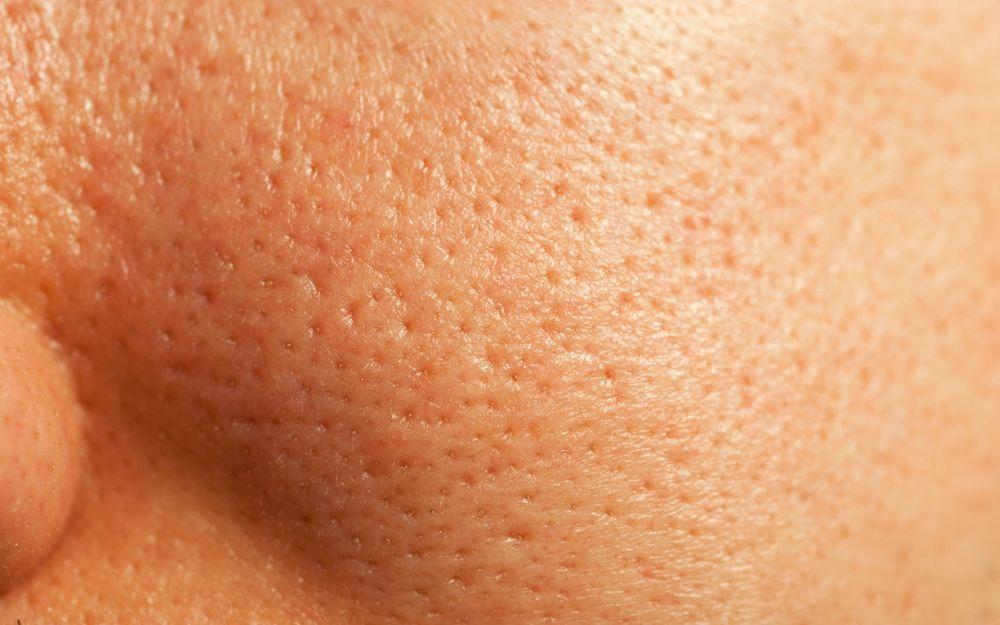 Sợi bã nhờn là gì? Nguyên nhân và cách làm giảm sợi bã nhờn hiệu quả